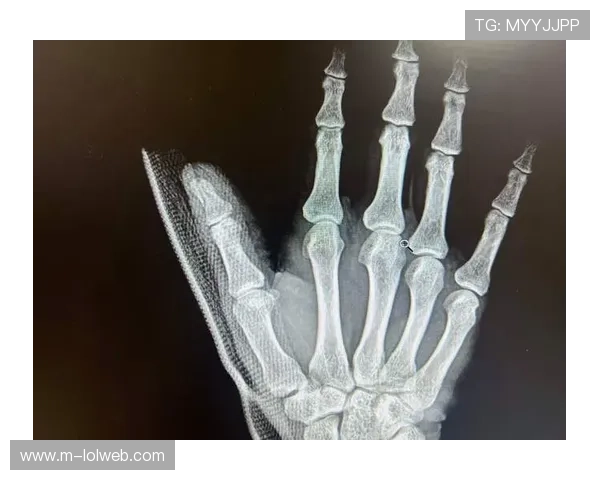 前锋鄂文慧全运会前中指骨折，咬牙坚持打完比赛